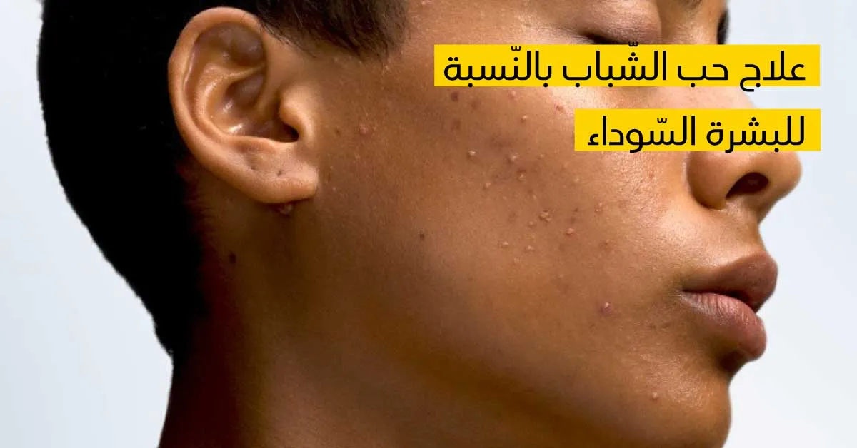  علاج حب الشّباب بالنّسبة للبشرة السّوداء 